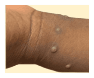 County Confirms First Clade I Mpox Case in San Diego Region