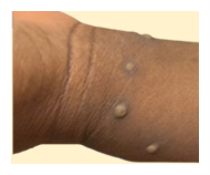 County Confirms First Clade I Mpox Case in San Diego Region